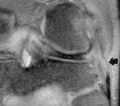 ligament_colateral