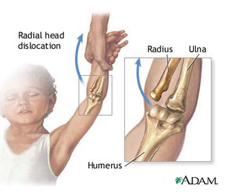 Cum să tratezi o articulație umflată pe braț, Negii comuni