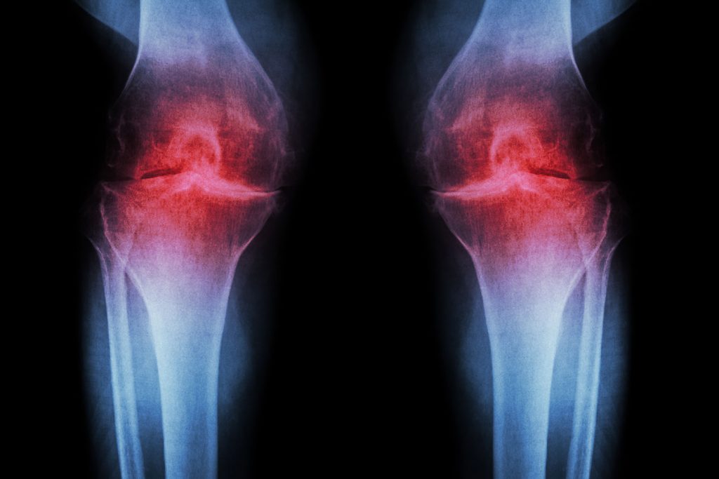 bursita simptomelor genunchiului și medicamentelor de tratament durere pe partea stângă a genunchiului